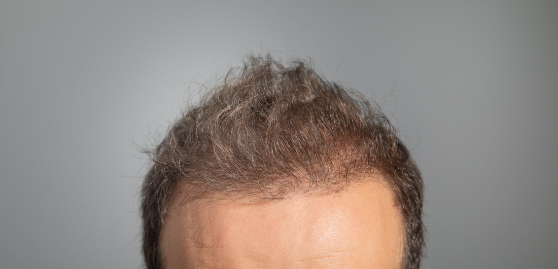 Top 3 Signs It's Time to Consider a Non-Surgical Hair System - Pro Hair Edit
